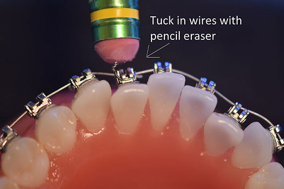 Tick In Wire With Pencil Eraser
