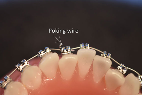 Poking Wire Ligature Tie