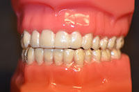 clear aligners