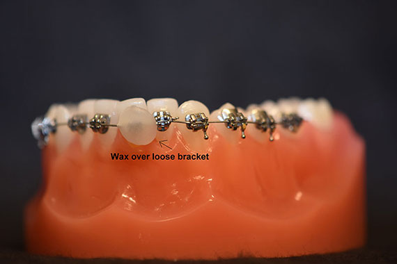 Loose Bracket with Wax