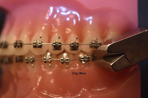 What to do when I have an orthodontic wire sticking out and poking the gums?