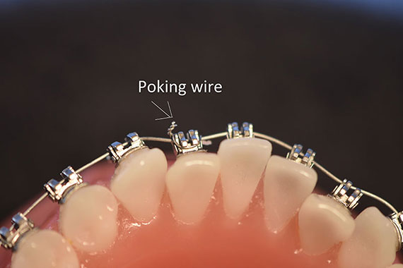 What to do when I have an orthodontic wire sticking out and poking the gums?