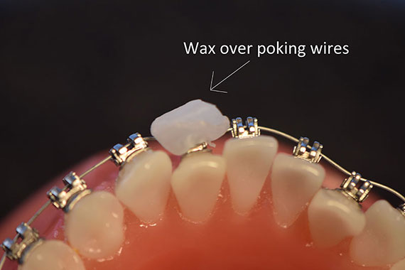 Wax over Poking Wires