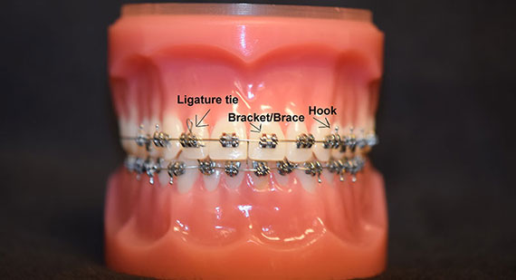 Parts of Braces