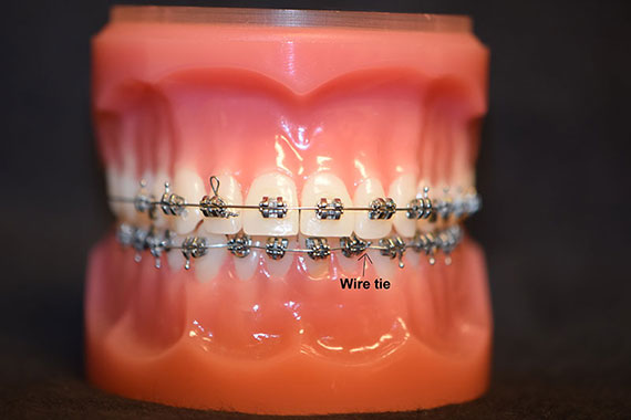 Parts of Braces