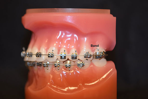 Gaps Between Teeth Before And After Braces Viechnicki Orthodontics