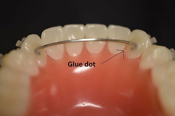 What to do when I have an orthodontic wire sticking out and poking the gums?