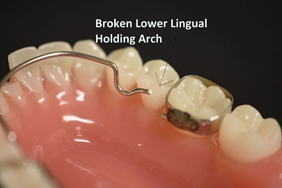 Broken Lower Lingual Holding Arch