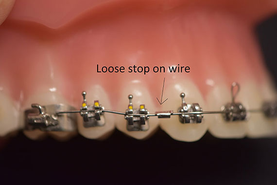 Loose Stop On Wire