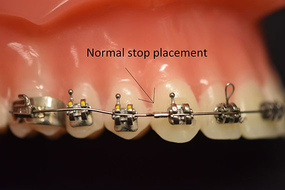 Normal Stop Placement