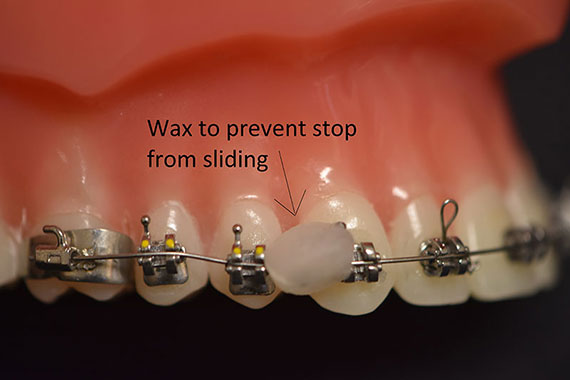 Wax to prevent stop from sliding