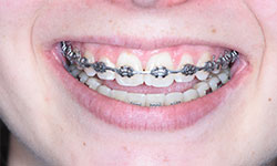 self-ligating braces