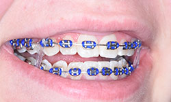 metal braces